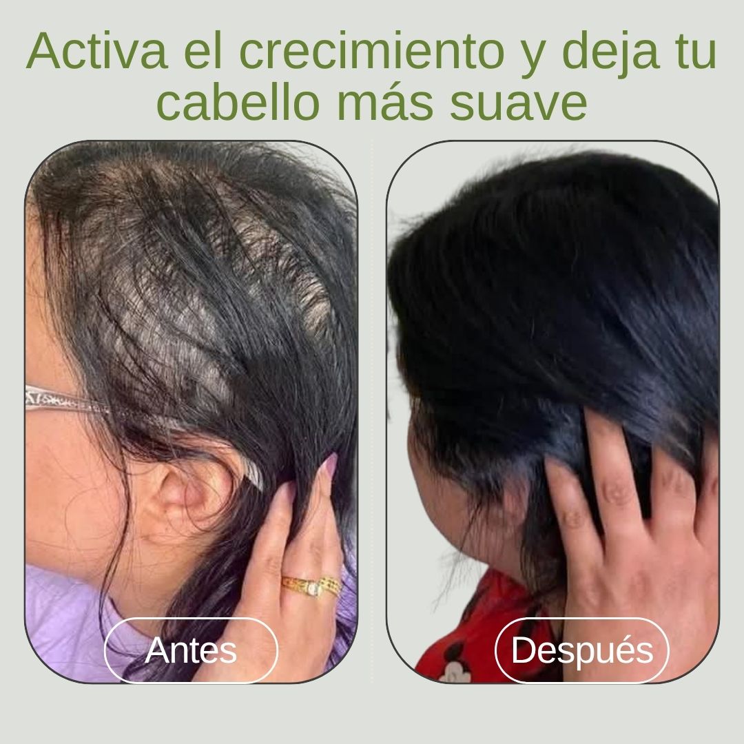 Kit CreceYA – ¡Bye Calvix! (-10% OFF + Envío Gratis + Regalo Gotas de seda).