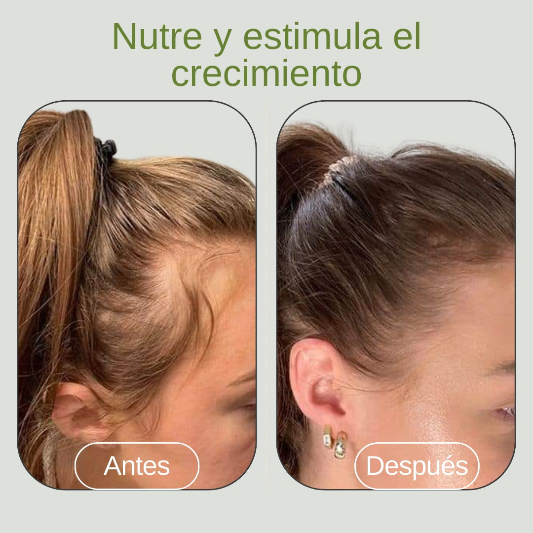 Kit Anti-Caída y Calvicie de Romero (-10% OFF + Envío Gratis + Regalo Sorpresa).