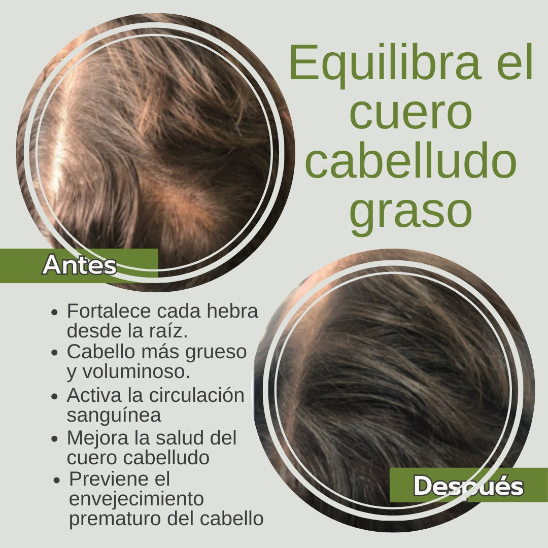 Kit Anti-Caída y Calvicie de Romero (-10% OFF + Envío Gratis + Regalo Sorpresa).